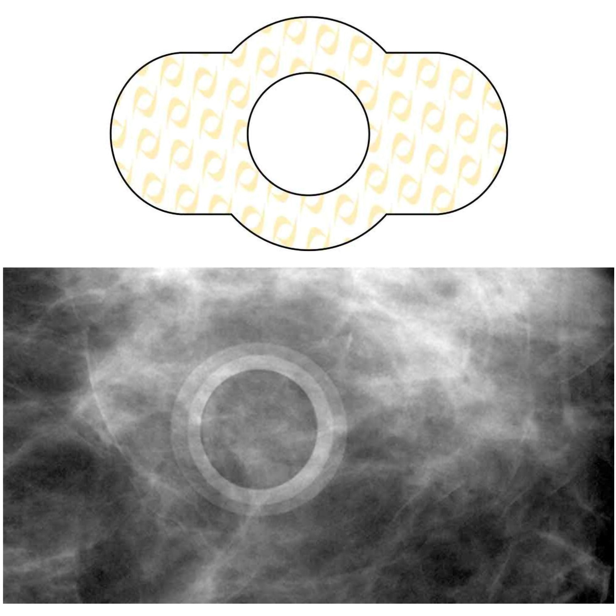 Spee-D-Ring™ Skin Marker SDG-M612