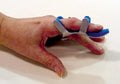Toad Finger Splint Medium Bulk PK/6: Comfortable Support for Finger Injuries