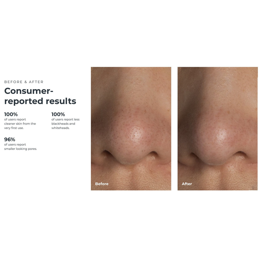 KIWI™ Blackhead Remover Pore Vaccum F1948