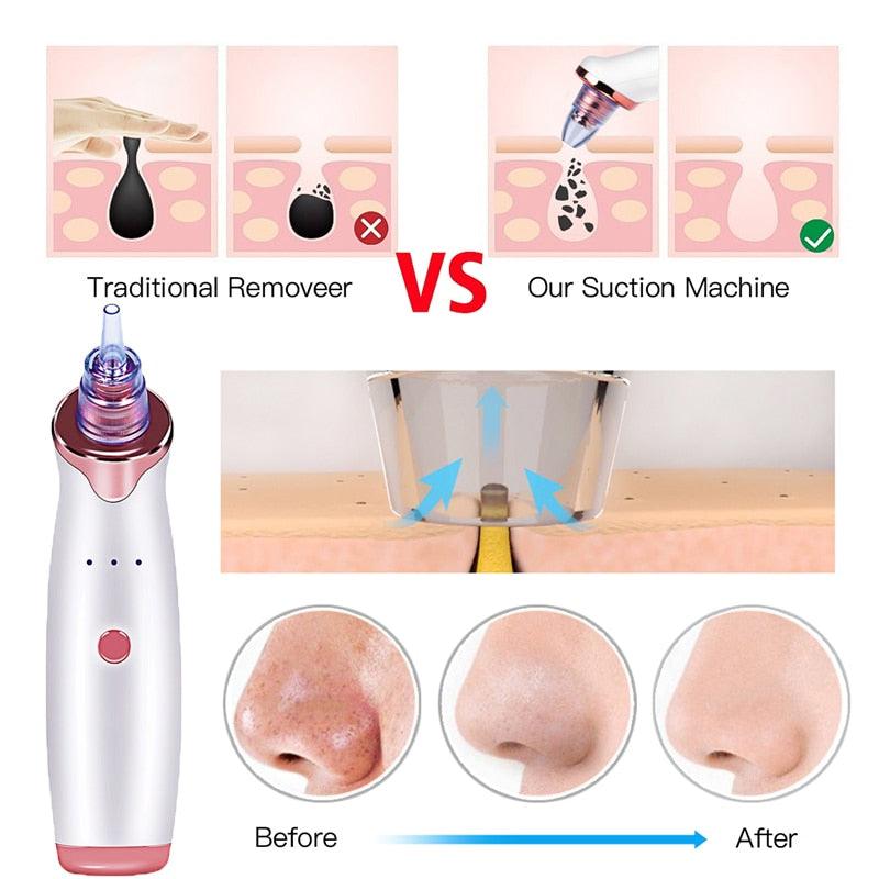 Multifunctional Beauty Pore Vacuum