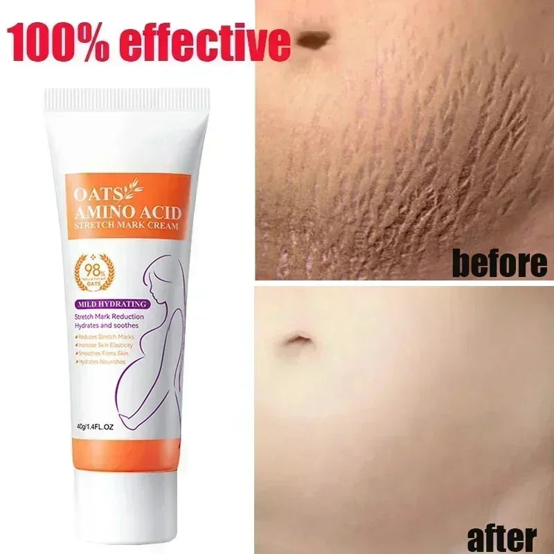 Cream For Pregnancy Stretch Marks Removal Eliminate Red White Old Stretch Marks 26