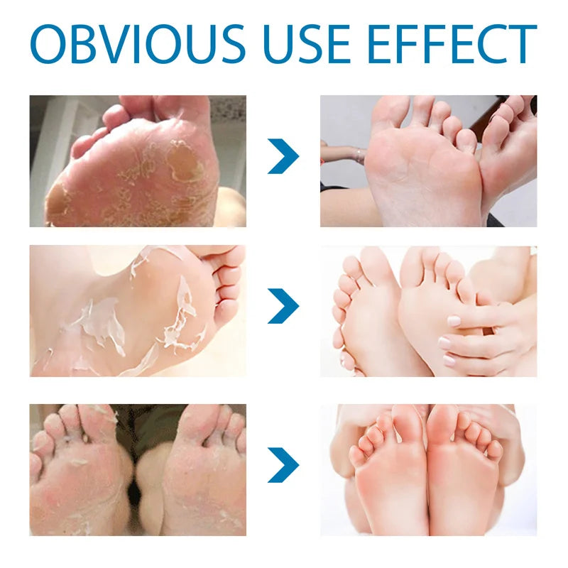 Exfoliating Foot Mask Feet Peeling Mask Spa Socks Smooth Dead Skin Remover Moisturizing Whitening Anti-Cracked Foot Skin Care