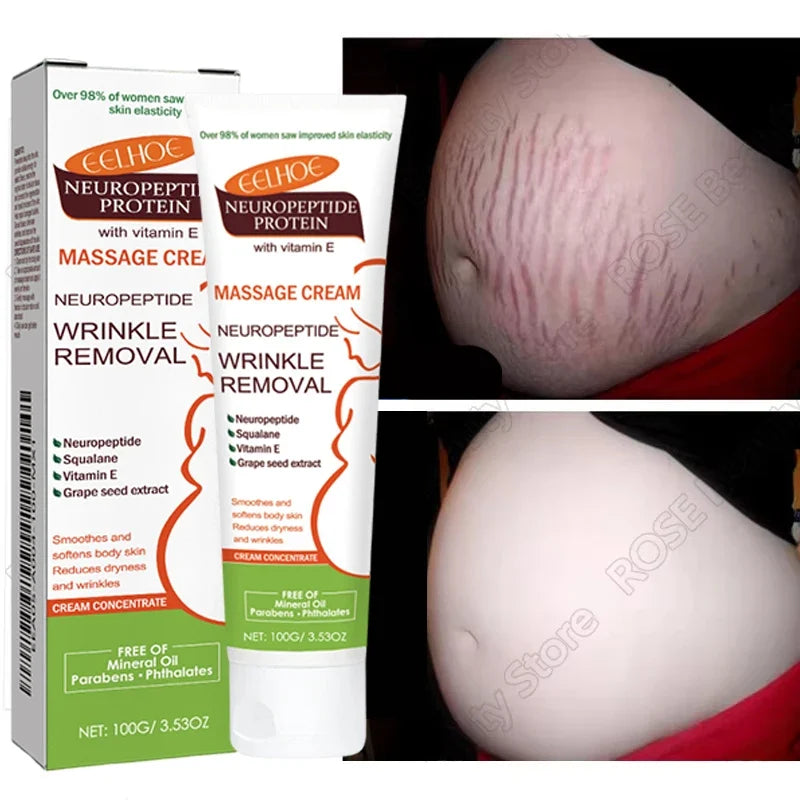 100g Stretch Marks Permanent Removal Cream Maternity Pregnant Women Pregnancy Anti-Winkle Smooth Repair Firming Skin Body Care
