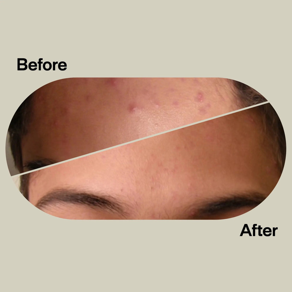 Acne Light Therapy Patch Kit ACDUO