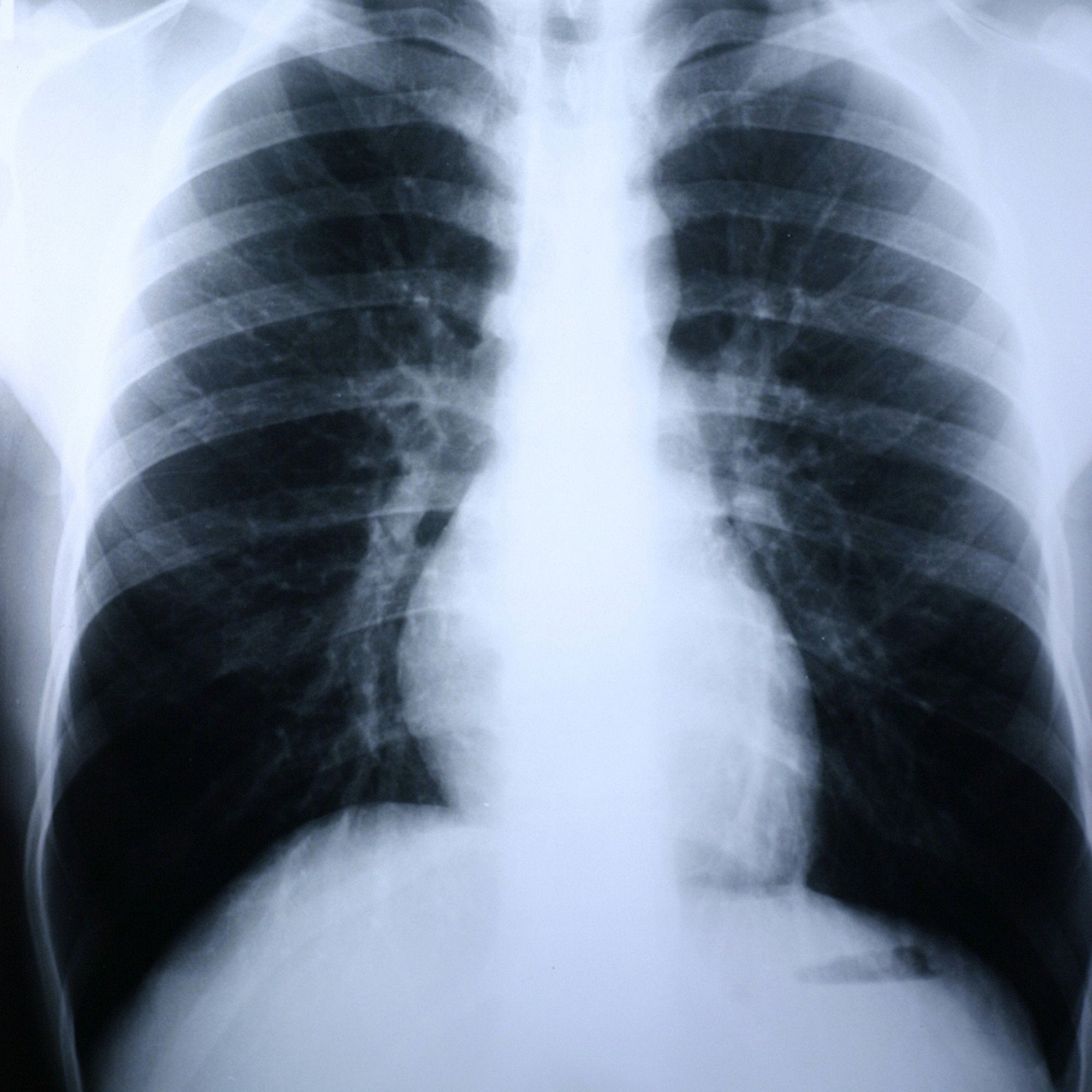 Clear Choice™ Performance X-Ray Film 55BUN