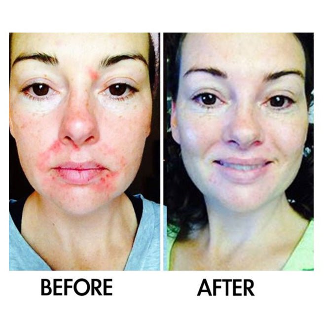 Derm 1 Adult Acne Two - Step Regimen plus FREE Blemish Corrector - PhishStones Products